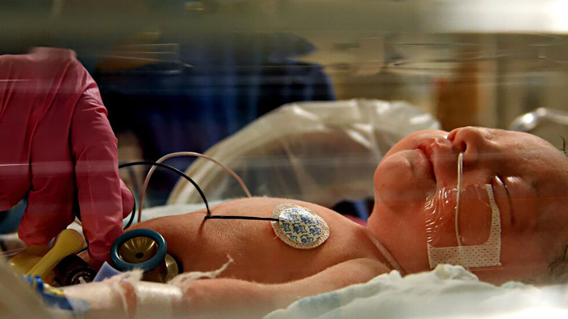 Lack of oxygen at birth: protecting the future of thousands of children  